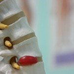 Spine and herniated disc.