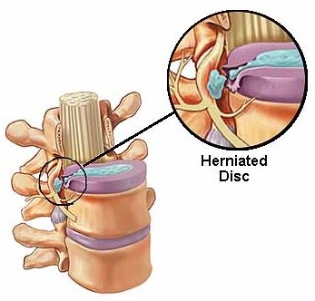 Herniated Disc Injury