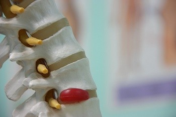 Spine and herniated disc.