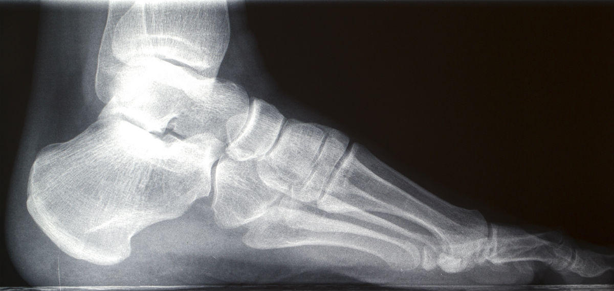 ankle x-ray