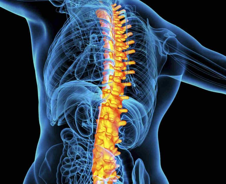 Compression Fracture from Car Accident Fractured Vertebrae Car Accident