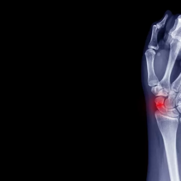 x-ray of a scaphoid fracture after a car accident