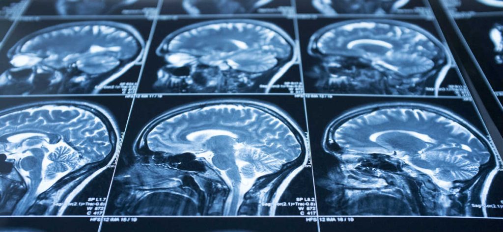 brain-stem-injury