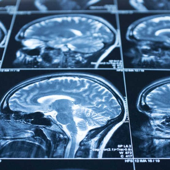 brain-stem-injury